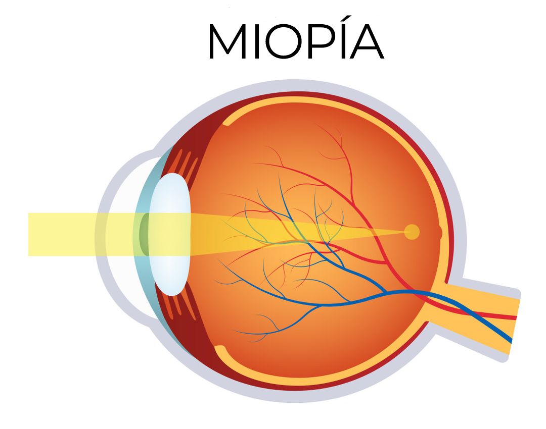 Imagen de la refracción de la luz en un ojo con miopía